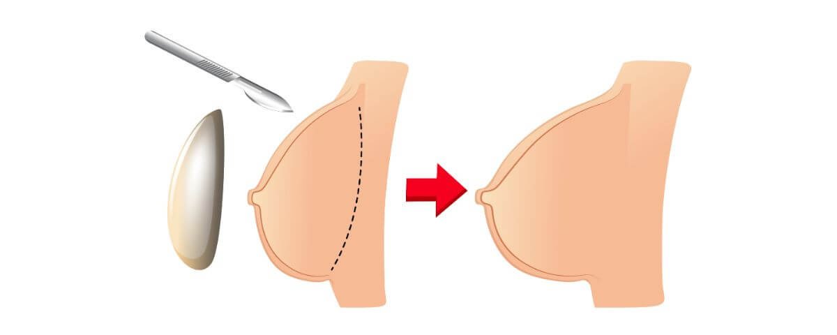 mamoplastia com silicone